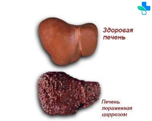 Цирроз печени